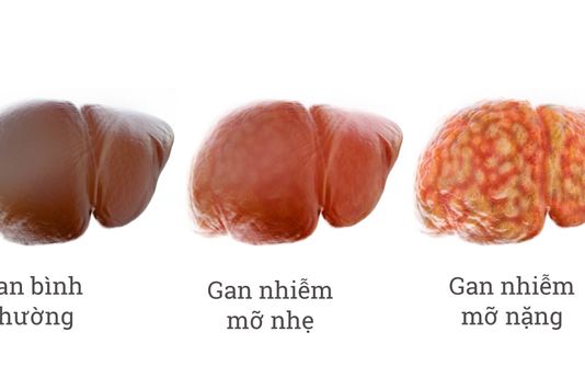 Người bị gan nhiễm mỡ nên ăn gì để tốt cho sức khỏe?